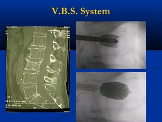 V.B.S. System
 