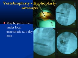 Vertebroplasty - Kyphoplasty
advantages
May be performed
under local
anaesthesia as a day
case
 