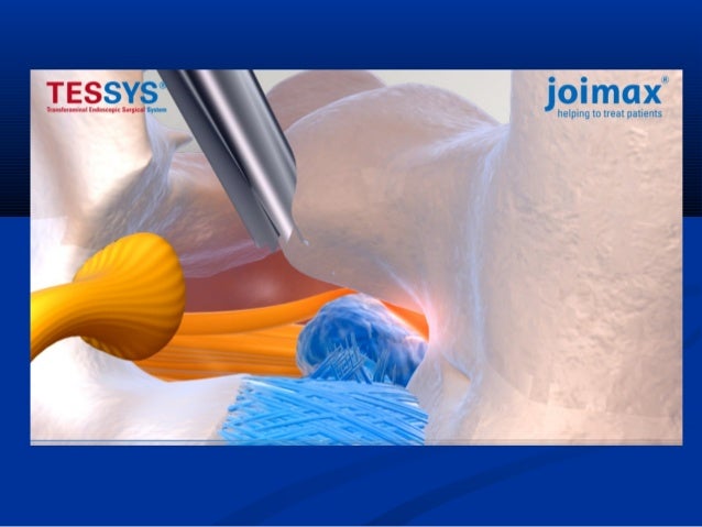 Scolio listhesis image