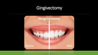 Gingivectomy
 