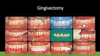Gingivectomy
 