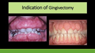 Indication of Gingivectomy
 