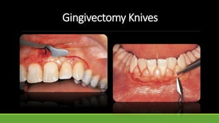Gingivectomy Knives
 