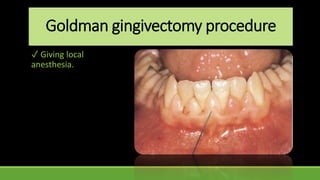 Goldman gingivectomy procedure
✓ Giving local
anesthesia.
 