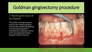 Goldman gingivectomy procedure
✓ Marking the Base of
the Pocket:
The pocket marking forceps is
used on the marginal gingiva
and also the interdental papillae
to create bleeding points
indicating the vestibular course
of the pseudopocket fundus
between teeth 43 and 33.
 