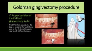 Goldman gingivectomy procedure
✓ Proper position of
the Kirkland
gingivectomy knife:
The GV knife is placed at a 45
degree angle to the tooth long
axis, at the first marking point
near tooth 33 from here a….
 