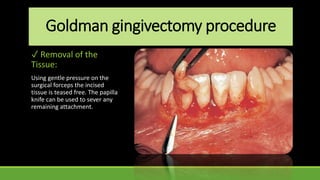 Goldman gingivectomy procedure
✓ Removal of the
Tissue:
Using gentle pressure on the
surgical forceps the incised
tissue is teased free. The papilla
knife can be used to sever any
remaining attachment.
 