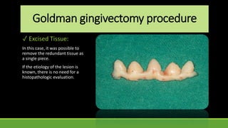 Goldman gingivectomy procedure
✓ Excised Tissue:
In this case, it was possible to
remove the redundant tissue as
a single piece.
If the etiology of the lesion is
known, there is no need for a
histopathologic evaluation.
 