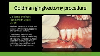 Goldman gingivectomy procedure
✓ Scaling and Root
Planing with Direct
Vision:
Removed any residual plaque and
calculus within the pseudopockets
after soft tissue removal.
Cleaning and planing of any
exposed root surfaces. In this way,
a biologically compatible surface is
created for the new junctional
epithelium that must form, and
the resulting gingival contour.
 