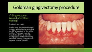 Goldman gingivectomy procedure
✓ Gingivectomy
Wound after Root
Planing:
The teeth are clean.
The incision line/wound margin
remains relatively sharp, despite
the 45° angulation of the initial
incision. This edge must be
rounded in order to provide
ideal gingival contour following
definitive healing (simplied oral
hygiene, plaque control).
 