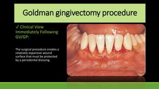 Goldman gingivectomy procedure
✓ Clinical View
Immediately Following
GV/GP:
The surgical procedure creates a
relatively expansive wound
surface that must be protected
by a periodontal dressing.
 