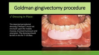 Goldman gingivectomy procedure
✓ Dressing In Place:
The depicted periodontal
dressing (“Peripac”) must not
encroach upon the mobile
mucosa, to prevent pressure and
ulceration. The dressing should
be left in situ for 7–10 days.
 