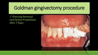 Goldman gingivectomy procedure
✓ Dressing Removal
and Dental Prophylaxis
after 7 Days
 