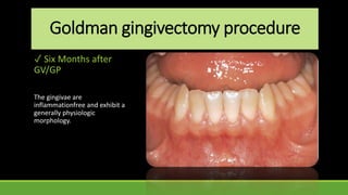 Goldman gingivectomy procedure
✓ Six Months after
GV/GP
The gingivae are
inflammationfree and exhibit a
generally physiologic
morphology.
 