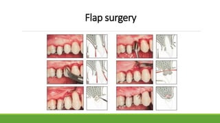 Flap surgery
 