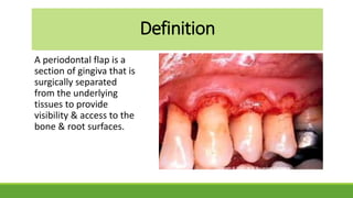 A periodontal flap is a
section of gingiva that is
surgically separated
from the underlying
tissues to provide
visibility & access to the
bone & root surfaces.
Definition
 