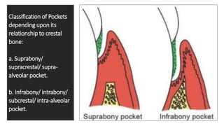 Classification of Pockets
depending upon its
relationship to crestal
bone:
a. Suprabony/
supracrestal/ supra-
alveolar pocket.
b. Infrabony/ intrabony/
subcrestal/ intra-alveolar
pocket.
 
