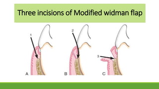 Three incisions of Modified widman flap
 