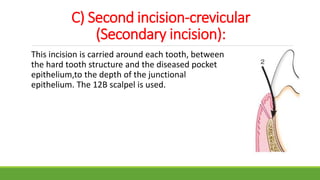 C) Second incision-crevicular
(Secondary incision):
This incision is carried around each tooth, between
the hard tooth structure and the diseased pocket
epithelium,to the depth of the junctional
epithelium. The 12B scalpel is used.
 