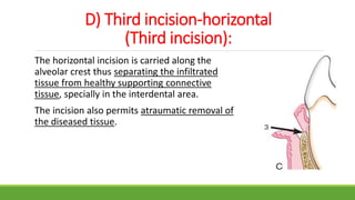 D) Third incision-horizontal
(Third incision):
The horizontal incision is carried along the
alveolar crest thus separating the infiltrated
tissue from healthy supporting connective
tissue, specially in the interdental area.
The incision also permits atraumatic removal of
the diseased tissue.
 