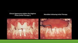 Clinical Appearance before the Hygiene
Phase (Initial Therapy I)
Mandible Following Initial Therapy
 