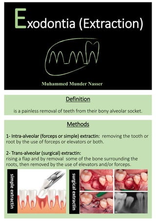 Definition
is a painless removal of teeth from their bony alveolar socket.
Methods
1- Intra-alveolar (forceps or simple) extractin: removing the tooth or
root by the use of forceps or elevators or both.
2- Trans-alveolar (surgical) extractin:
rising a flap and by removal some of the bone surrounding the
roots, then removed by the use of elevators and/or forceps.
Exodontia (Extraction)
simple
extractin
surgical
extractin
 
