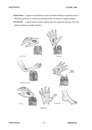OSTENSIVO CAAML 1206
OSTENSIVO ORIGINAL
8-2
•Penetrantes – o agente causal penetra em uma cavidade fechada do organismo como a
abdominal, torácica ou craniana, provocando lesões em tecidos ou órgãos internos.
•Perfurante – o agente apenas perfura alguma parte do organismo humano, mas sem
atingir cavidades ou órgãos internos.
Figura 8.1
 