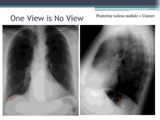 One View is No View Posterior sulcus nodule = Cancer
 