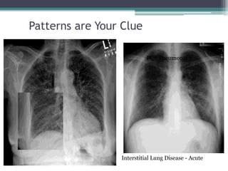 Patterns are Your Clue
Interstitial Lung Disease - Acute
PCP Pneumonia
CHF
 