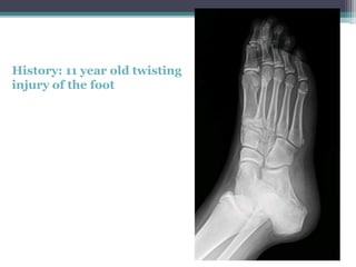 History: 11 year old twisting
injury of the foot
 