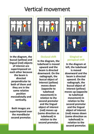 Vertical movement
In the diagram, the
buccal (yellow) and
lingual (red) objects
of interest are
superimposed on
each other because
the beam is
directed
perpendicular to
both of them and
they are in the
same relative
position
mesiodistally and
vertically.
Both images are
superimposed over
the mandibular
second premolar.
Occlusal shift
In the diagram, the
tubehead is moved
upward and the
beam is directed
downward. On the
radiograph, the
buccal object of
interest (yellow)
moves down
(opposite to
tubehead
movement) in
relation to the
second premolar
and the lingual
object of interest
(red) moves up
(same direction as
tubehead) in
relation to the
second premolar.
Gingival or
periapical shift
In the diagram at
left, the tubehead
is moved
downward and the
beam is directed
upward. On the
radiograph, the
buccal object of
interest (yellow)
moves up (opposite
to tubehead
movement) in
relation to the
second premolar
and the lingual
object of interest
(red) moves down
(same direction as
tubehead) in
relation to the
second premolar.
 