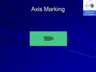 Eastwood
Eye Surgery
Axis Marking
 