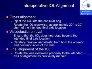 Eastwood
Eye Surgery
Intraoperative IOL Alignment
Gross alignment
– Inject the IOL into the capsular bag
– Rotate the IOL clockwise, approximately 20° to 30°
short of the intended final axis location
Viscoelastic removal
– Ensure that the IOL does not rotate beyond the
intended final axis location
– Carefully remove viscoelastic from both the anterior
and posterior sides of the lens
Final alignment of the IOL
– Rotate the lens clockwise precisely to the intended
axis of alignment as previously marked
 