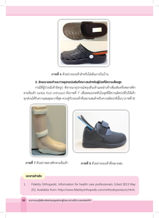 ภาพที่ 6 ตัวอย่างรองเท้าส�ำหรับใส่เดินภายในบ้าน
	 3. ลักษณะรองเท้าและกายอุปกรณ์เสริมที่เหมาะสมส�ำหรับผู้ป่วยที่มีความเสี่ยงสูง
	 กรณีที่ผู้ป่วยมีเท้าผิดรูป พิจารณาอุปกรณ์พยุงส้นเท้าและฝ่าเท้าเพิ่มเติมหรือพลาสติก
ดามข้อเท้า (ankle foot orthoses) ดังภาพที่ 71
เพื่อลดแรงกดทับในจุดที่มีความผิดปกติไปให้เท้า
ทุกส่วนได้รับความสมดุลมากที่สุด ควบคู่กับรองเท้าที่เหมาะสมส�ำหรับความผิดปกตินั้นๆ (ภาพที่ 8)
ภาพที่ 7 ตัวอย่างพลาสติกดามข้อเท้า ภาพที่ 8 ตัวอย่างรองเท้าที่เหมาะสม
1. 	 Fidelity Orthopedic. Information for health care professionals. [cited 2013 May
21]. Available from: http://www.fidelityorthopedic.com/orthodicproducts.html.
เอกสารอ้างอิง
66 แนวทางเวชปฏิบัติการป้องกันและดูแลรักษาผู้ป่วยเบาหวานที่มีภาวะแทรกซ้อนที่เท้า
 