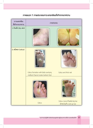 ภาวะแทรกซ้อน
ที่เท้าจากเบาหวาน
ภาพประกอบ
1. ผิวแห้ง (dry skin)
2. หนังหนา (callus)
Callus
Callus formation with bleb overlying
midfoot Charcot rocker bottom foot
Callus and thick nail
Callus /ulcer ตำ�แหน่ง big toe
มักพบร่วมกับ cock-up toe
ภาคผนวก 7 ภาพประกอบภาวะแทรกซ้อนที่เท้าจากเบาหวาน
67แนวทางเวชปฏิบัติการป้องกันและดูแลรักษาผู้ป่วยเบาหวานที่มีภาวะแทรกซ้อนที่เท้า
 