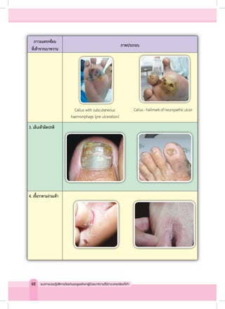 ภาวะแทรกซ้อน
ที่เท้าจากเบาหวาน
ภาพประกอบ
3. เล็บเท้าผิดปกติ
4. เชื้อราตามง่ามเท้า
Callus with subcutaneous
haemorrphage (pre ulceration)
Callus-hallmarkofneuropathiculcer
68 แนวทางเวชปฏิบัติการป้องกันและดูแลรักษาผู้ป่วยเบาหวานที่มีภาวะแทรกซ้อนที่เท้า
 