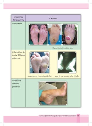 ภาวะแทรกซ้อน
ที่เท้าจากเบาหวาน
ภาพประกอบ
5. Charcot foot
6. Charcot foot de-
formity ที่มี Rocker
bottom sole
7. ฝ่าเท้าโก่งงอ
มากกว่าปกติ
(pes cavus)
Charcot foot with midfoot ulcer
Rocker bottom Charcot foot (เท้าซ้าย) X-ray ท่า true lateral สำ�หรับการวินิจฉัย
69แนวทางเวชปฏิบัติการป้องกันและดูแลรักษาผู้ป่วยเบาหวานที่มีภาวะแทรกซ้อนที่เท้า
 
