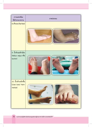 ภาวะแทรกซ้อน
ที่เท้าจากเบาหวาน
ภาพประกอบ
8.เท้าแบน(flatfeet)
9. นิ้วหัวแม่เท้าเอียง
(Hallux valgus หรือ
bunion)
10. นิ้วเท้างอจิกพื้น
(claw toes/ Ham-
mertoe)
70 แนวทางเวชปฏิบัติการป้องกันและดูแลรักษาผู้ป่วยเบาหวานที่มีภาวะแทรกซ้อนที่เท้า
 