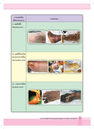 ภาวะแทรกซ้อน
ที่เท้าจากเบาหวาน
ภาพประกอบ
11. แผลติดเชื้อ
(infected ulcer)
12. แผลที่เกิดจากโรค
ปลายประสาทเสื่อม
(neuropathiculcer)
13. แผลขาดเลือด
(ischemic ulcer)
71แนวทางเวชปฏิบัติการป้องกันและดูแลรักษาผู้ป่วยเบาหวานที่มีภาวะแทรกซ้อนที่เท้า
 