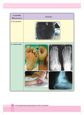 ภาวะแทรกซ้อน
ที่เท้าจากเบาหวาน
ภาพประกอบ
14. Dry gangrene
15. Osteomyelitis
72 แนวทางเวชปฏิบัติการป้องกันและดูแลรักษาผู้ป่วยเบาหวานที่มีภาวะแทรกซ้อนที่เท้า
 
