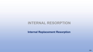 INTERNAL RESORPTION
126
Internal Replacement Resorption
 