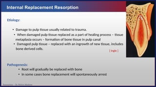Resorption – Dr. Nithin Mathew
Internal Replacement Resorption
Etiology:
• Damage to pulp tissue usually related to trauma.
• When damaged pulp tissue replaced as a part of healing process – tissue
metaplasia occurs – formation of bone tissue in pulp canal
• Damaged pulp tissue – replaced with an ingrowth of new tissue, includes
bone derived cells.
Pathogenesis:
• Root will gradually be replaced with bone
• In some cases bone replacement will spontaneously arrest
[ Ingle ]
 