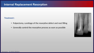 Resorption – Dr. Nithin Mathew
Internal Replacement Resorption
Treatment :
• Pulpectomy, curettage of the resorptive defect and root filling
• Generally control the resorptive process as soon as possible
 