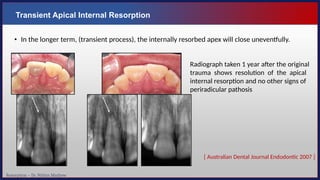 Resorption – Dr. Nithin Mathew
Transient Apical Internal Resorption
• In the longer term, (transient process), the internally resorbed apex will close uneventfully.
[ Australian Dental Journal Endodontic 2007 ]
Radiograph taken 1 year after the original
trauma shows resolution of the apical
internal resorption and no other signs of
periradicular pathosis
 