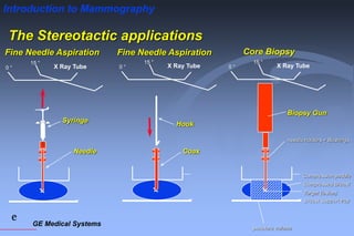 GE Medical Systems
e
Introduction to Mammography
The Stereotactic applications
0 °
15 °
X Ray Tube
Syringe
Needle
Fine Needle Aspiration
0 °
15 °
X Ray Tube
Coax
Hook
Fine Needle Aspiration
Breast Support tray
Compression paddle
Compressed Breast
Target (lesion)
needle holders + Bushings
0 °
15 °
puncture volume
X Ray Tube
Biopsy Gun
Core Biopsy
 