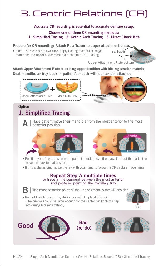 singles in pala Resistant to high levels of pala a contiguous region of dna approximately 44 kilobases long which included the cad gene was amplified in five of five single. singles in pala Resistant to high levels of pala a contiguous region of dna approximately 44 kilobases long which included the cad gene was amplified in five of five single.