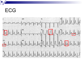 ECG 