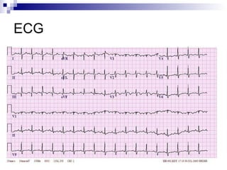ECG 