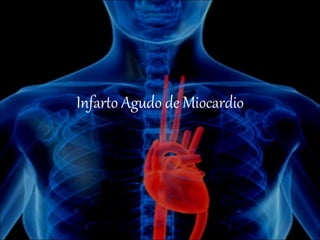 Infarto Agudo de Miocardio
 