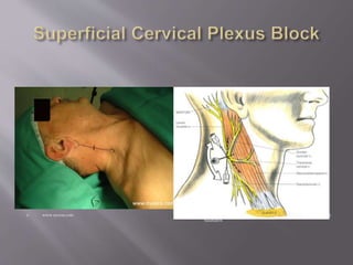 www.nysora.com  Brown: Atlas of Regional Anesthesia, 3rd ed., Copyright © 2006
Saunders
 